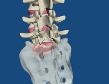 spine3