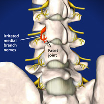 Lumbar-Radiofrequency-Neurotomy