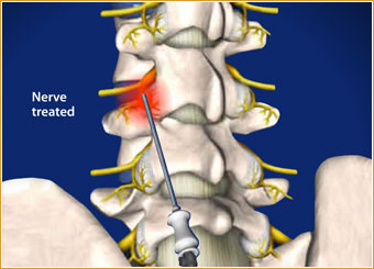 radiofrequency-neurotomy