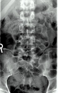 SPINE SURGERY SEATTLE