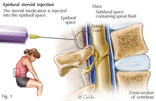 epidural injection