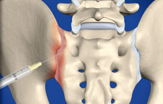 sacroiliac_joint