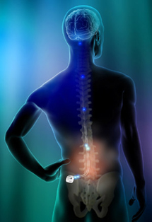 spinal-cord-stimu-3